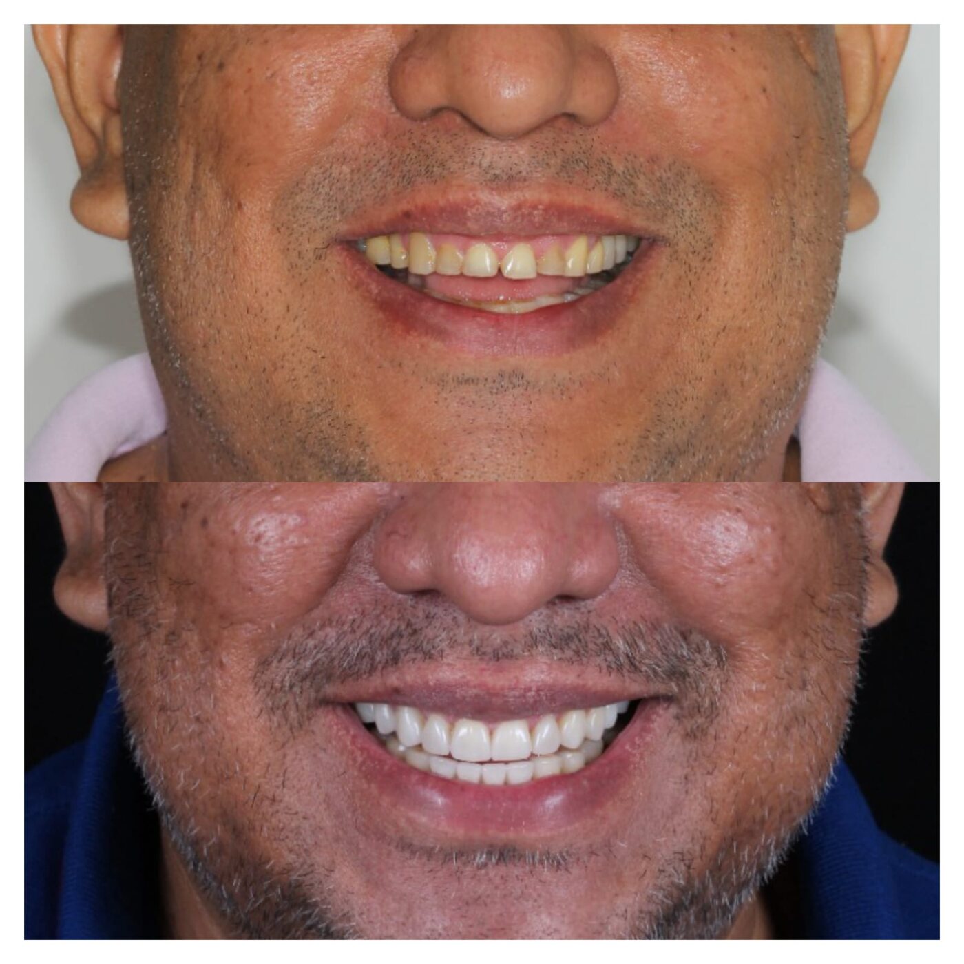 Antes e depois de lentes de contato dental — Joel